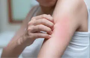 A girl scratching her arm with skin rash, a sign of asthma or allergy symptoms in Bristow, VA, linked to crawl space problems.